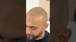 Hairline is back scalpmicropigmentation [upl. by Aba]