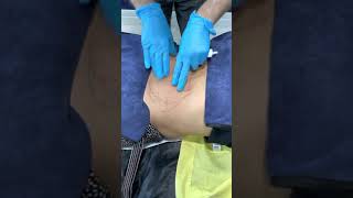 Fat Dissolving Injection to Belly [upl. by Erreid]