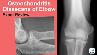 Osteochondritis Dissecans of Elbow Exam Review  Christopher S Ahmad MD [upl. by Angela58]