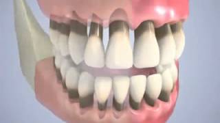 bruxism or clenching of teeth [upl. by Beutler]