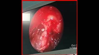 endoscopic craniopharyngioma excission [upl. by Bricker]