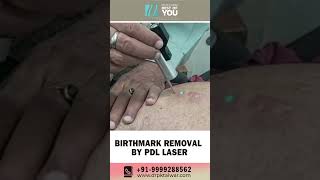 Birthmark Removal by PDL Laser  Pulsed Dye Laser Treatment in Delhi  Dr PK Talwar [upl. by Dittman]