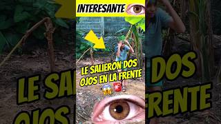 A este joven le salieron dos ojos en la frente 😰😱 Interesante Asombróso 😰😱 [upl. by Lenneuq]