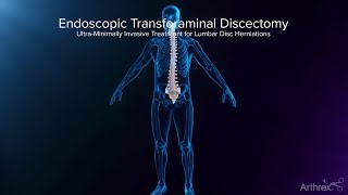 Endoscopic Transforaminal Approach for a Herniated Disc [upl. by Kamal]