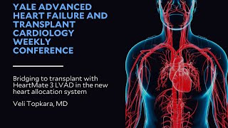 Bridging to transplant with HeartMate 3 LVAD in the new heart allocation system [upl. by Ahsiened]