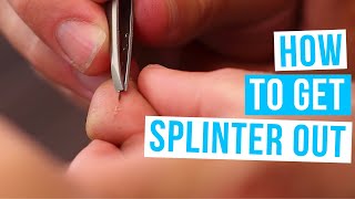 How to GET A SPLINTER OUT  Get rid of splinters with or without tweezers [upl. by Kellina]