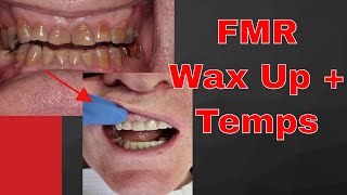 Adhesive Full Mouth Rehabs Part 2  Wax Up and Temporaries  PDP106 [upl. by Krock]