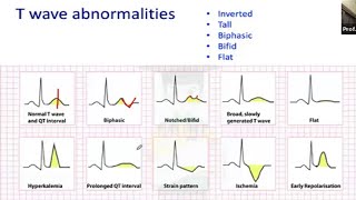 T wave in ECG by Dr M Atahar Ali sir [upl. by Swords]