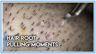 Hair Root Pulling Moments HAIR TRANSPLANT SURGERY [upl. by Ciri]