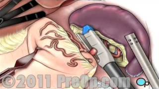 Spleen Removal Surgery Laparoscopic Splenectomy PreOp® Patient Education [upl. by Arihsay]