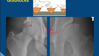 MRI Hip Imaging of Femoral Acetabular Impingement [upl. by Asela30]