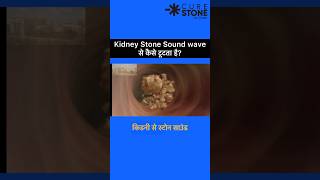 ESWL  Lithotripsy  Kidney Stone Treatment  Retrograde Intrarenal Surgery  shorts [upl. by Gala571]