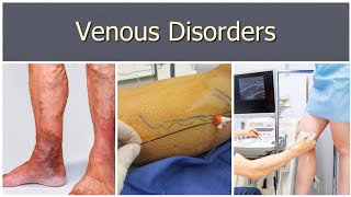 Venous Disorders 3  Saphena Varix Deep Venous Thrombosis [upl. by Cohlier14]