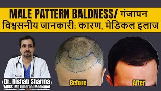 Causes Best Treatment Home Remedies In Hindi I Androgenic Alopecia I Male Pattern Baldness Cure [upl. by Kohl]