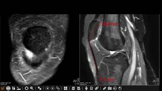 Patellar tendonlateral femoral condyle friction syndrome Hoffa fat pad impingement syndrome [upl. by Birck]