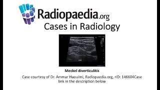 Meckel diverticulitis Radiopaediaorg Cases in Radiology [upl. by Amandy646]