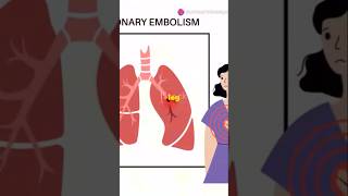 Pulmonary Embolism Explained What Every Med Student Needs to Know PulmonaryEmbolism medstudent [upl. by Eahsed]