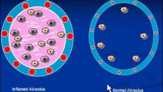 Pneumonia Streptococcal Pneumonia [upl. by Eima303]