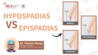 Hypospadias vs Epispadias  Dr Gautam Banga  SCI Hospital [upl. by Siloa]