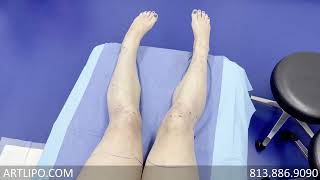 Cankles amp Knees Liposuction  Lipedema Legs  Expert Dr Thomas Su [upl. by Swithin530]