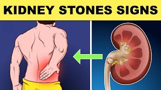 Kidney Stones Symptoms  All You Need to Know [upl. by Patterman783]