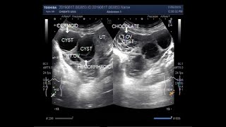 Ultrasound Video showing Three types of Cysts in the same patient [upl. by Notanhoj]