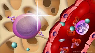 Waldenström’s Macroglobulinemia [upl. by Jaine]