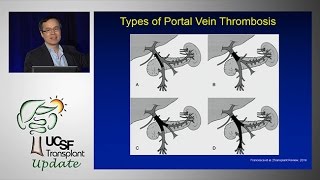 Portal Vein Thrombosis Medical and Surgical Consideration  UCSF Liver Transplant Conference 2014 [upl. by Turk]