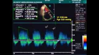 valvular heart disease [upl. by Oyek]