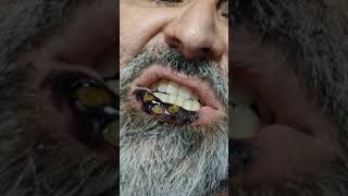 Botfly Maggot Removal spa doctor satisfying pimple removal [upl. by Aelaza]