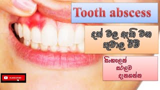 Dentaltooth abscess දත්වල තුවාල ඇති වීම් how it happens causes symptoms treatment how prevent [upl. by Animrelliug425]