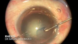 Tips amp Tricks in Making Rhexis During Phaco Cataract Surgery [upl. by Dennett643]