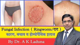 Ringworm Fungal Infection Complete information [upl. by Eltsirc]