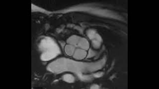 Cardiac MRI quardricuspid aortic valve [upl. by Ammeg435]