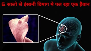 इस आदमी के Brain में 6 सालों से पल रहा था ये हैवान Monster Developed Inside human brain till 6 year [upl. by Ordnas688]