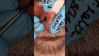 Nose Blackheads  Removal by DrLalit Kasana [upl. by Gustaf]