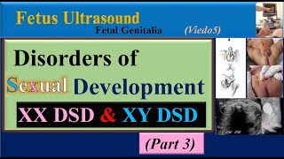 Fetus Ultrasound Disorders of Sexual Development Part3 [upl. by Nenerb213]