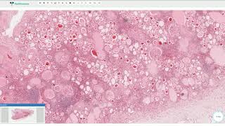 Chronic Pyelonephritis  Kidney Histopathology [upl. by Nediarb]