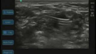 Ultrasound Guided Interscalene Catheter [upl. by Nylevol]