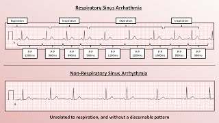 Advanced EKGs  Sinus Node Dysfunction [upl. by Inez]