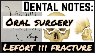 LEFORT III FRACTURE II MIDFACE FRACTURE II ORAL SURGERY [upl. by Bernie]