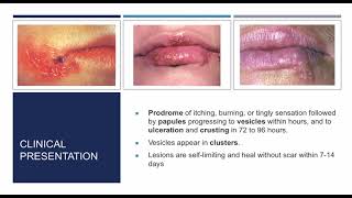 Gingival diseases in children part 2 [upl. by Eek]