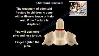 Odontoid Fractures  Everything You Need To Know  Dr Nabil Ebraheim [upl. by Pascoe]