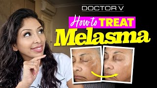 Doctor V  How To Treat Melasma  Skin Of Colour  Brown Or Black Skin [upl. by Norat]