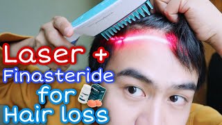 Hairmax laser comb  Finasteride 2 years update for HAIR LOSS [upl. by Enaira]