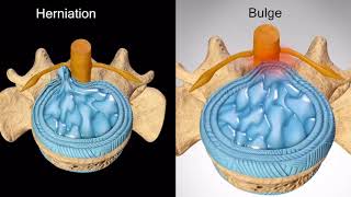 Disc Bulge vs Disc Herniation [upl. by Kinelski802]