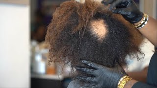 Female Pattern Baldness The ALOPECIA EPISODE‼️ [upl. by Seek690]