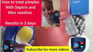 How to treat pimples With Septrin and Men vaseline pimples tiktokuganda kadama [upl. by Albric485]