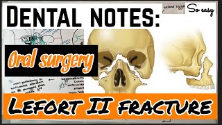 LEFORT II FRACTURE  ORAL SUREGRY  so easy [upl. by Nocam]