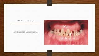 What is Microdontia  small teeth By DrAmin [upl. by Anana]